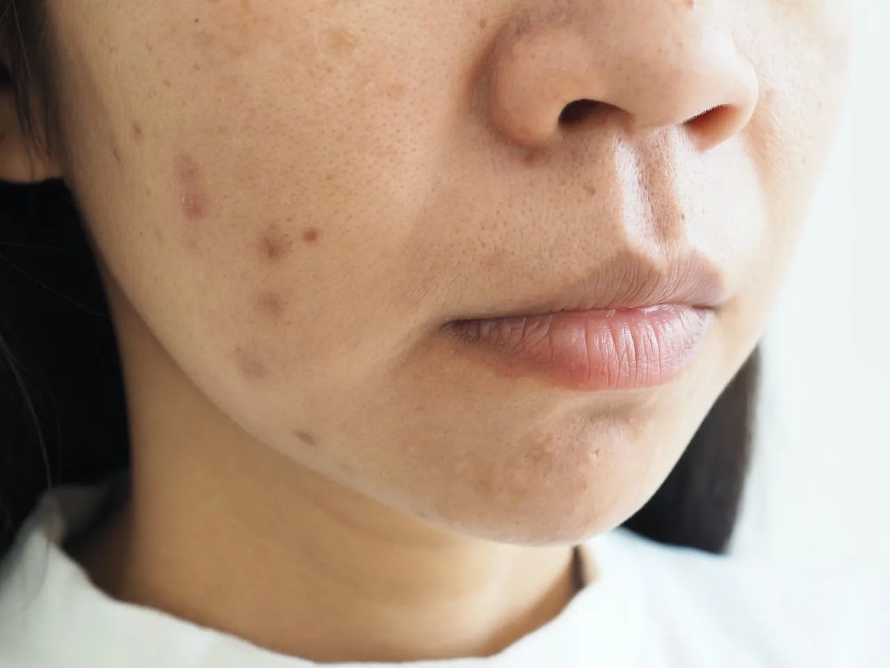 Dark Spots / Pigmentation