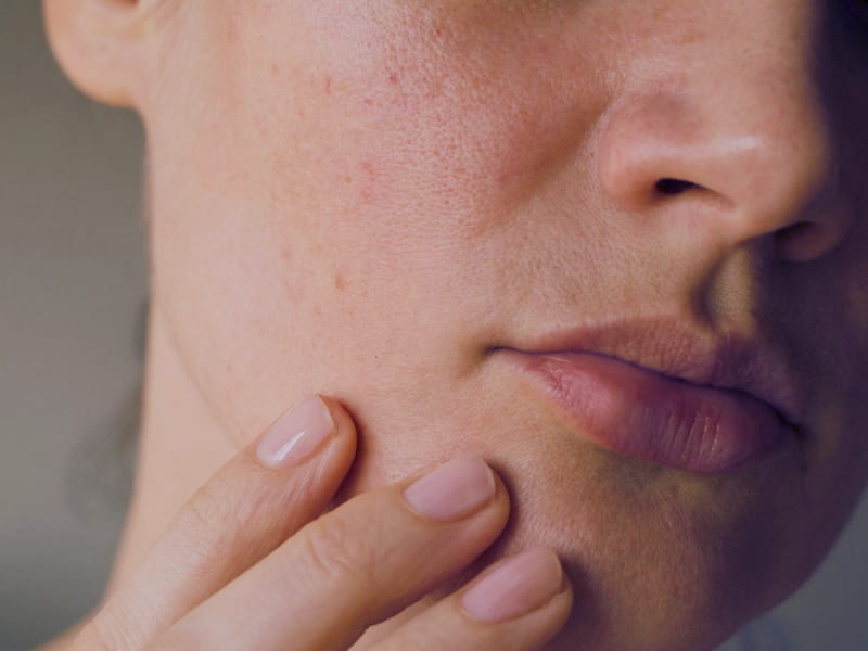 Dryness / Dehydration